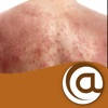 Atopic Dermatitis @PoC