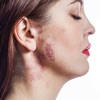 All Skin Diseases Infections