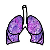 Lung Cancer Stage Lung Cancer Stage