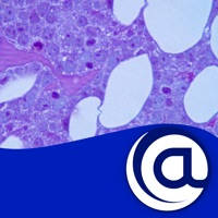 Multiple Myeloma @PoC