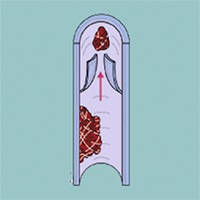 Thromboembolism Risk Thromboembolism Risk